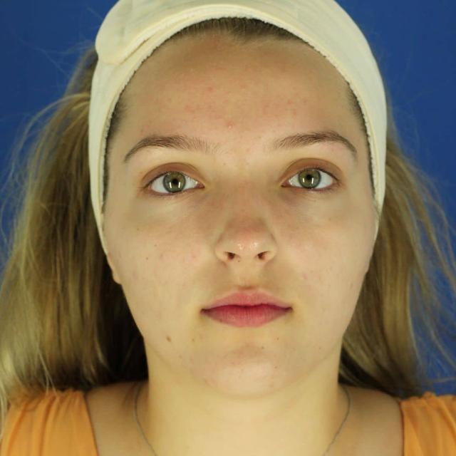 Microneedling after at EvolvMD MedSpa & Wellness I Milwaukee, WI in Wauwatosa, WI