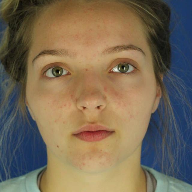 Microneedling before at EvolvMD MedSpa & Wellness I Milwaukee, WI in Wauwatosa, WI