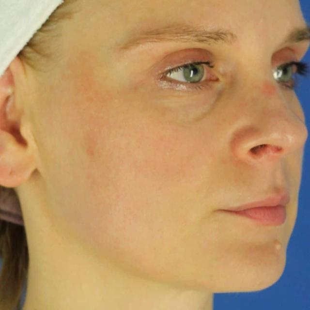 Morpheus8 after at EvolvMD MedSpa & Wellness I Milwaukee, WI in Wauwatosa, WI