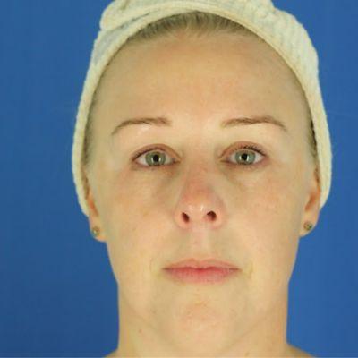 EvolvMD MedSpa & Wellness I Milwaukee, WI microneedling after — Wauwatosa, WI