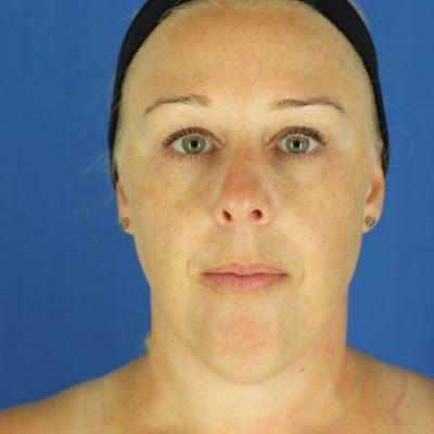 Morpheus8 before at EvolvMD MedSpa & Wellness I Milwaukee, WI in Wauwatosa, WI