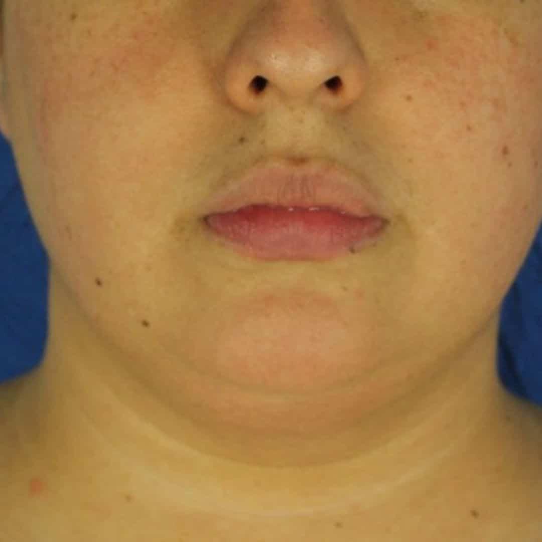 EvolvMD MedSpa & Wellness I Milwaukee, WI microneedling after — Wauwatosa, WI