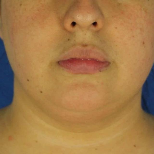 Microneedling after at EvolvMD MedSpa & Wellness I Milwaukee, WI in Wauwatosa, WI