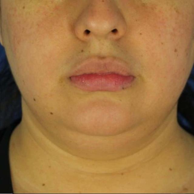 Microneedling before at EvolvMD MedSpa & Wellness I Milwaukee, WI in Wauwatosa, WI