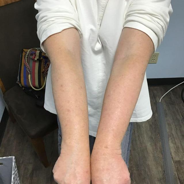 Brazilian Butt Lift after at EvolvMD MedSpa & Wellness I Milwaukee, WI in Wauwatosa, WI