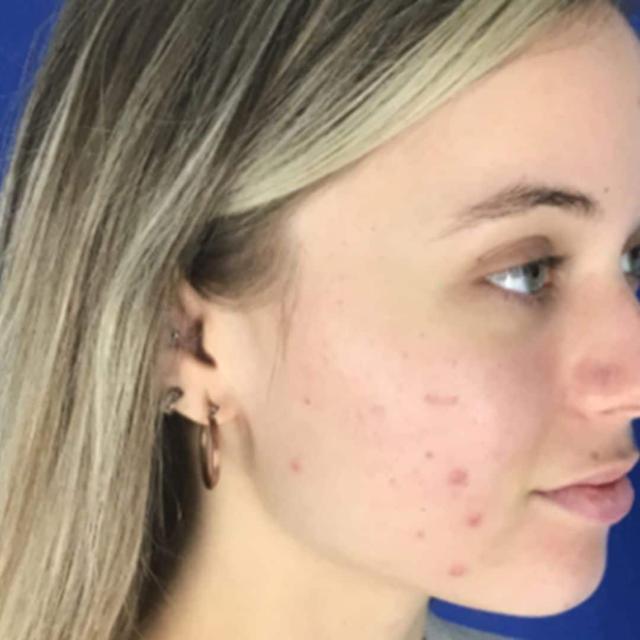 Morpheus8 after at EvolvMD MedSpa & Wellness I Milwaukee, WI in Wauwatosa, WI