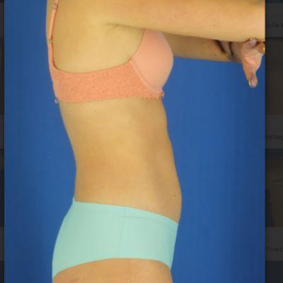 Liposuction after at EvolvMD MedSpa & Wellness I Milwaukee, WI in Wauwatosa, WI