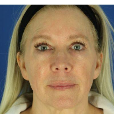 EvolvMD MedSpa & Wellness I Milwaukee, WI microneedling after — Wauwatosa, WI