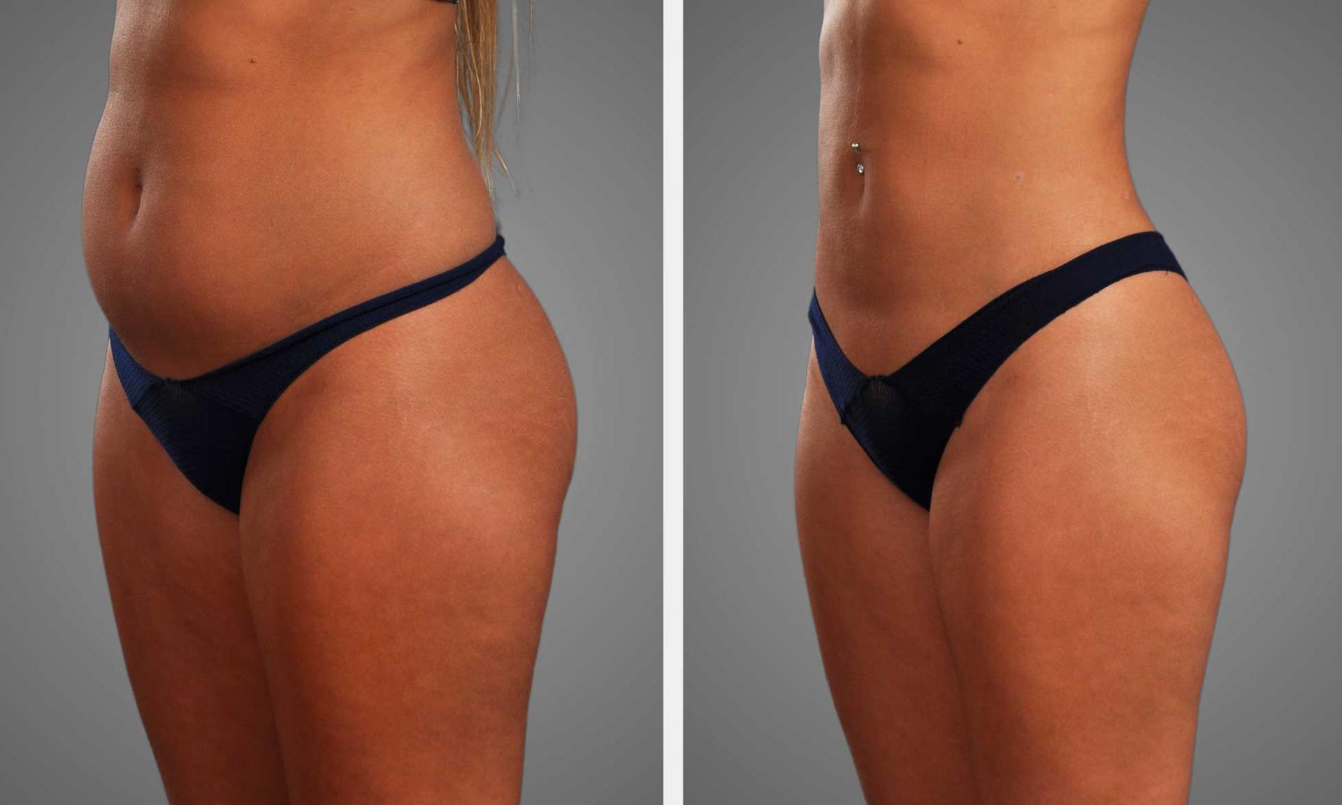 Infini Phoenix Liposuction result — Scottsdale, AZ