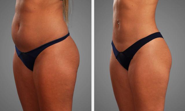 Liposuction result at Infini Phoenix Liposuction in Scottsdale, AZ