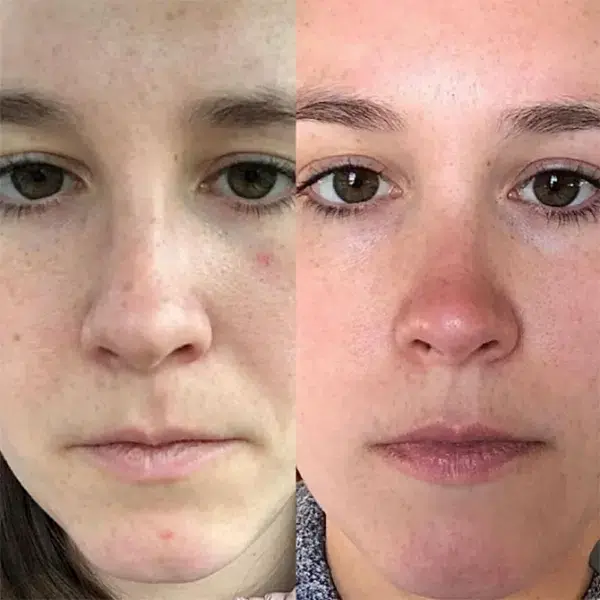 Monroe MedSpa - Buffalo result — Buffalo, NY