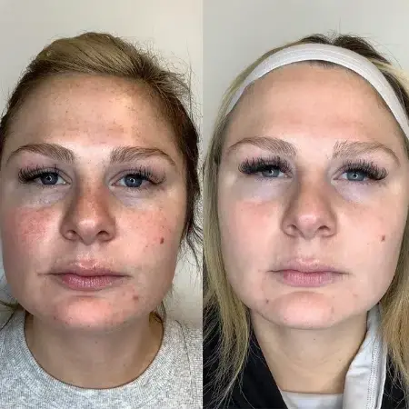 Brazilian Butt Lift result at Monroe MedSpa - Buffalo in Buffalo, NY