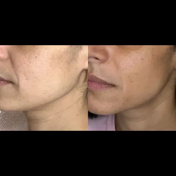 Monroe MedSpa - Buffalo result — Buffalo, NY
