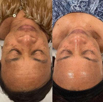 Chemical Peel result at Monroe MedSpa - Buffalo in Buffalo, NY