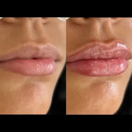 Lip Filler result at Monroe MedSpa - Buffalo in Buffalo, NY