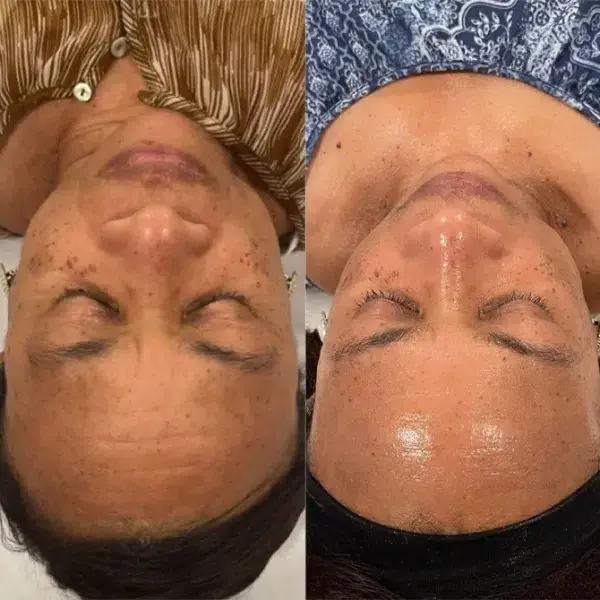 Chemical Peel result at Monroe MedSpa - Buffalo in Buffalo, NY