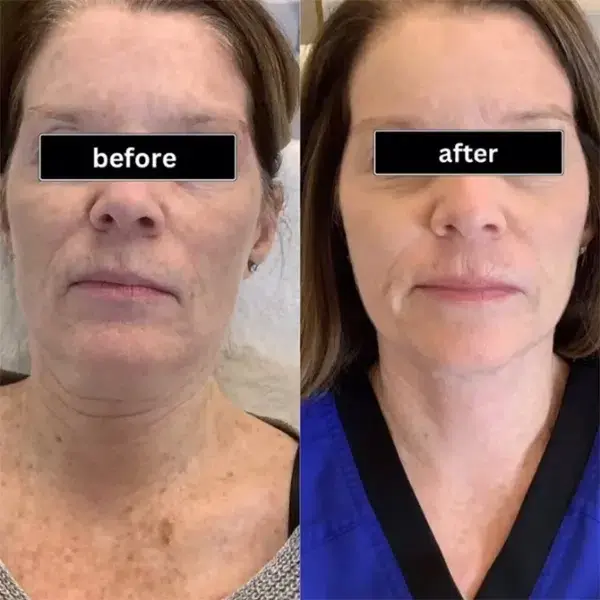 Monroe MedSpa - Buffalo result — Buffalo, NY