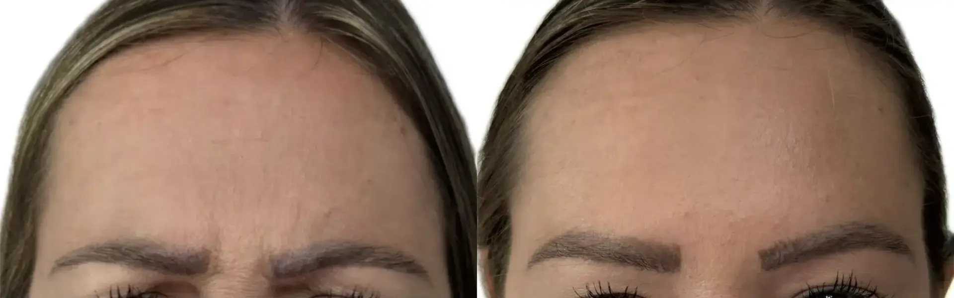 Monroe MedSpa - Buffalo botox result — Buffalo, NY