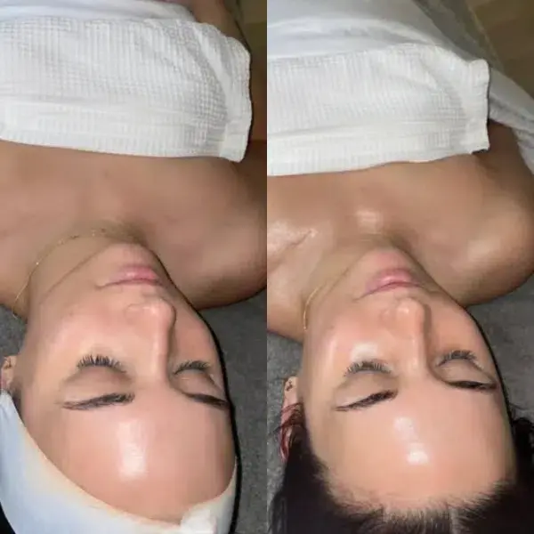 Chemical Peel result at Monroe MedSpa - Buffalo in Buffalo, NY