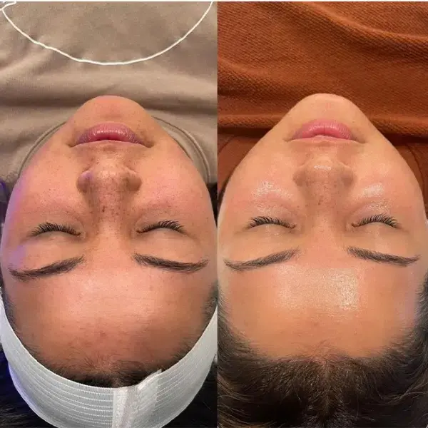 Laser Skin Resurfacing result at Monroe MedSpa - Buffalo in Buffalo, NY