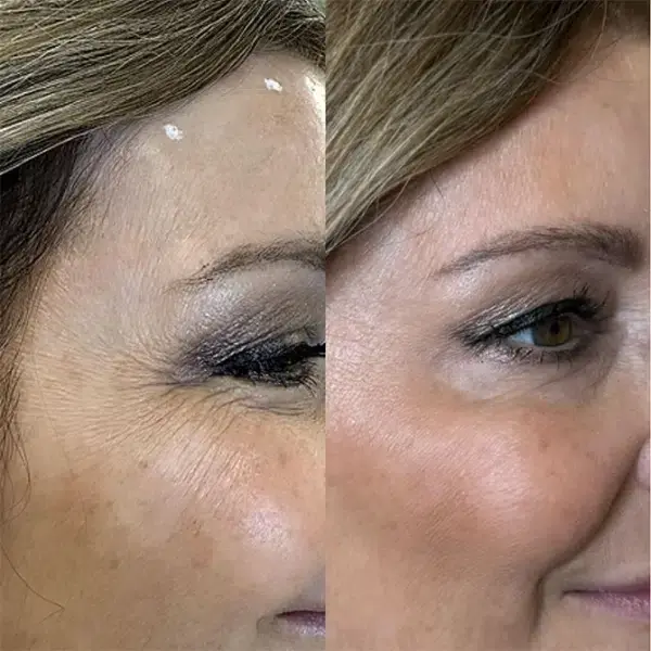 Botox result at Monroe MedSpa - Buffalo in Buffalo, NY