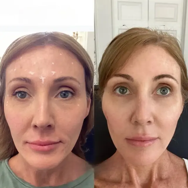 Juvederm result at Monroe MedSpa - Buffalo in Buffalo, NY