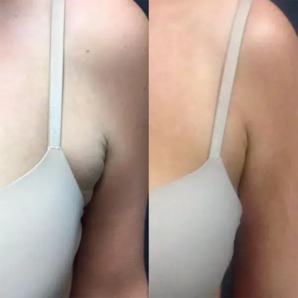 Monroe MedSpa - Buffalo coolsculpting result — Buffalo, NY