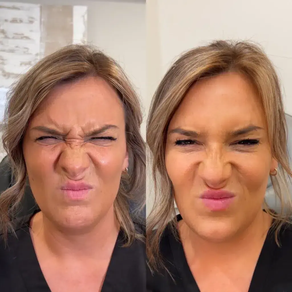 Monroe MedSpa - Buffalo botox result — Buffalo, NY