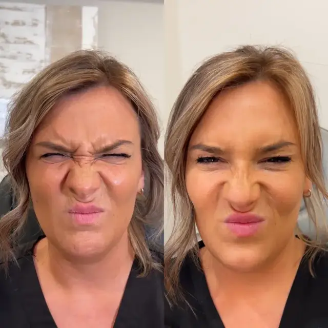 Botox result at Monroe MedSpa - Buffalo in Buffalo, NY