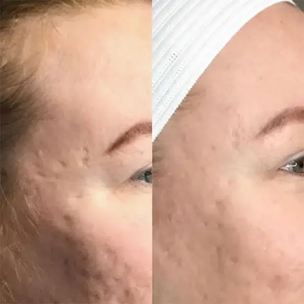 Microneedling result at Monroe MedSpa - Buffalo in Buffalo, NY