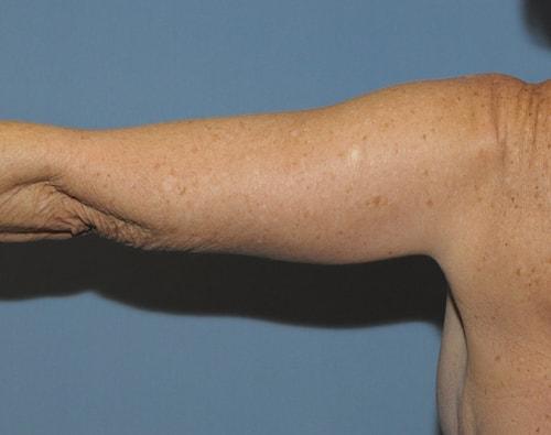 Arm Lift after at Dr. Robert G Bonillas MD in Scottsdale, AZ