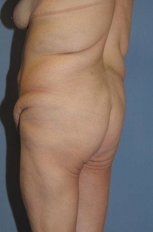 Thigh Lift before at Dr. Robert G Bonillas MD in Scottsdale, AZ