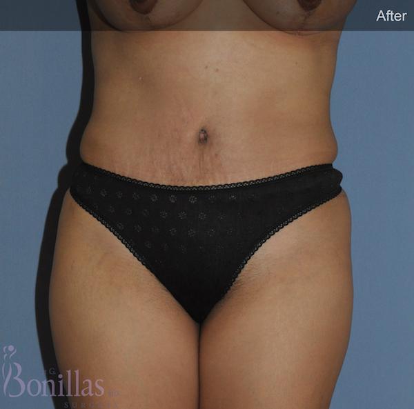 Dr. Robert G Bonillas MD tummy tuck after — Scottsdale, AZ