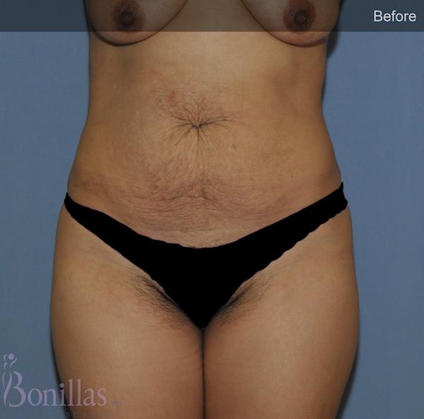 Tummy Tuck before at Dr. Robert G Bonillas MD in Scottsdale, AZ