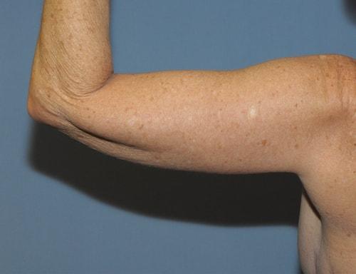 Arm Lift after at Dr. Robert G Bonillas MD in Scottsdale, AZ