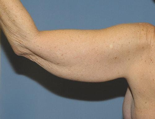 Arm Lift before at Dr. Robert G Bonillas MD in Scottsdale, AZ
