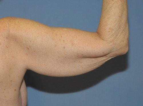 Arm Lift before at Dr. Robert G Bonillas MD in Scottsdale, AZ