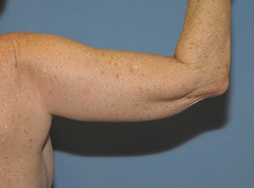 Arm Lift after at Dr. Robert G Bonillas MD in Scottsdale, AZ