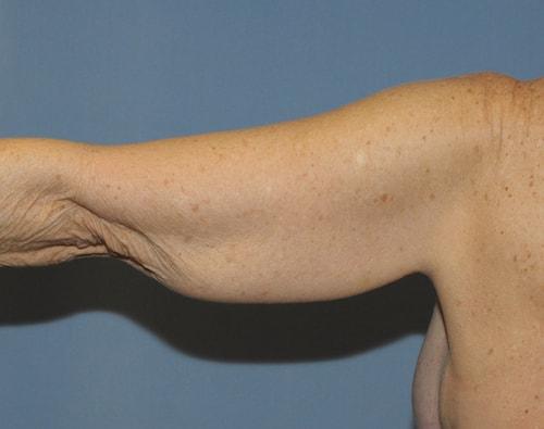 Arm Lift before at Dr. Robert G Bonillas MD in Scottsdale, AZ