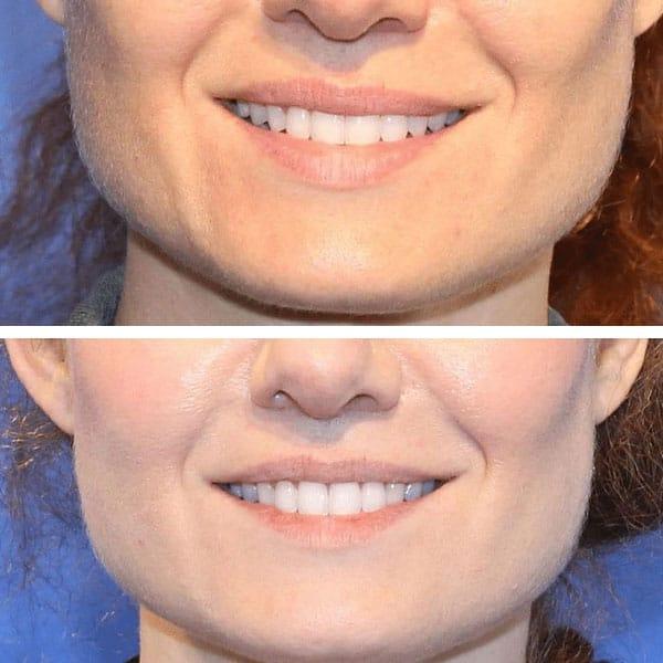 Chin Implant result at Jeff Lisiecki, MD in New York, NY