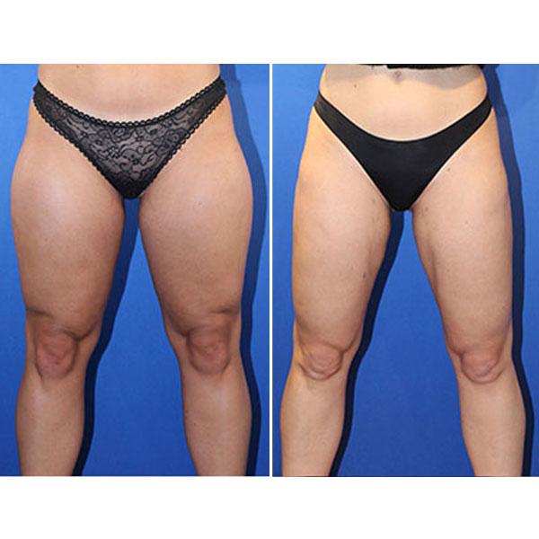 Jeff Lisiecki, MD liposuction result — New York, NY