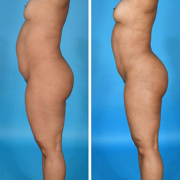 Jeff Lisiecki, MD liposuction result — New York, NY