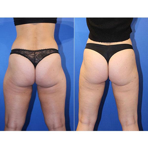 Jeff Lisiecki, MD liposuction result — New York, NY