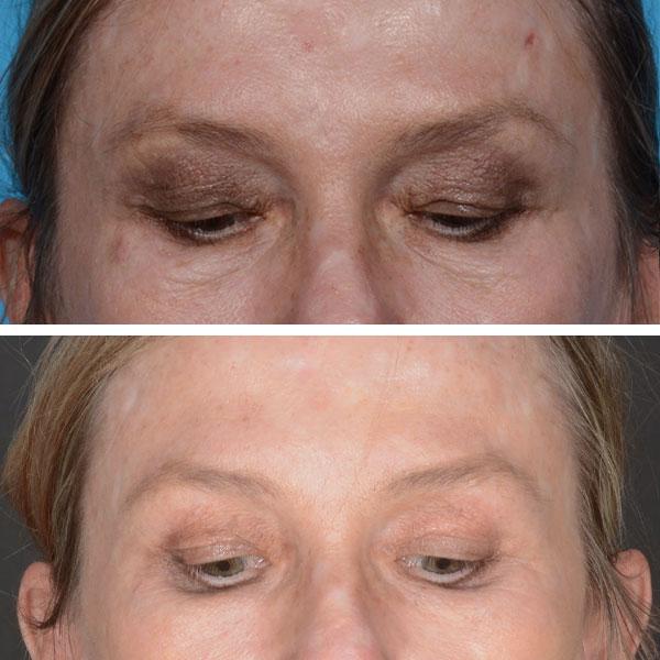 Blepharoplasty result at Jeff Lisiecki, MD in New York, NY