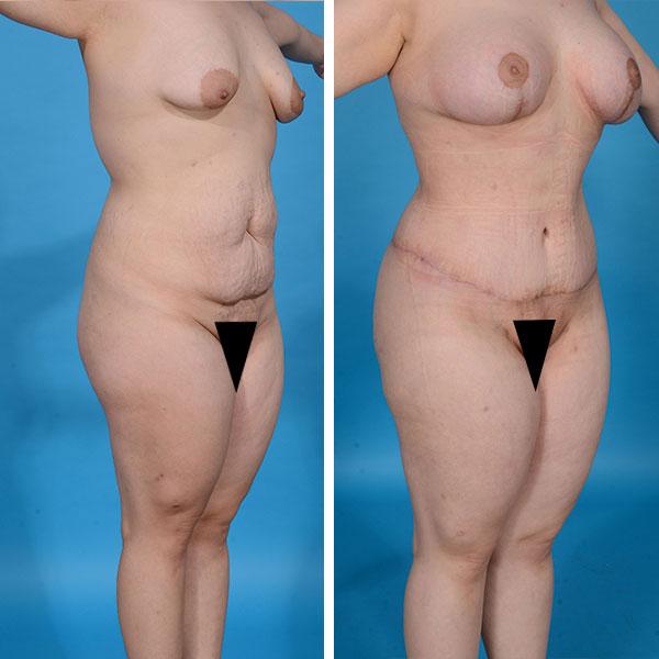 Mommy Makeover result at Jeff Lisiecki, MD in New York, NY