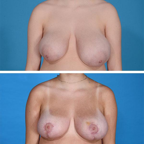 Breast Reduction result at Jeff Lisiecki, MD in New York, NY