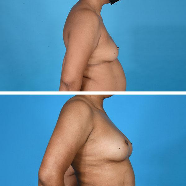 Breast Augmentation result at Jeff Lisiecki, MD in New York, NY