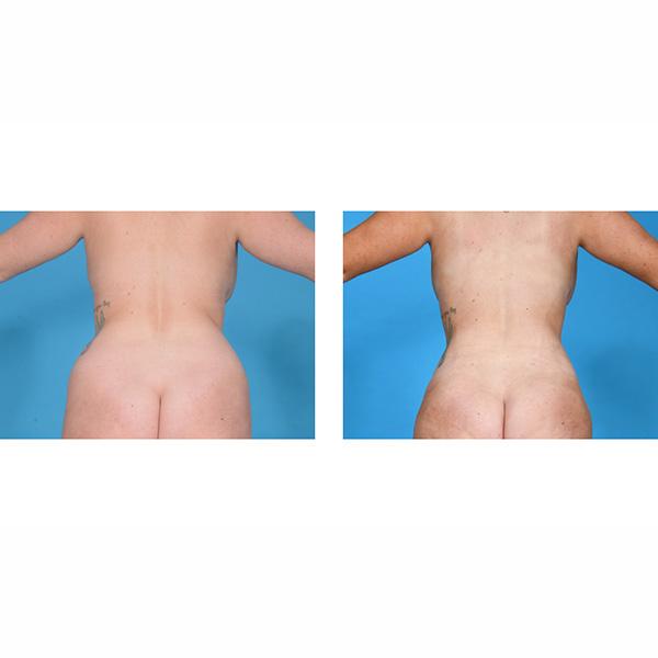 Liposuction result at Jeff Lisiecki, MD in New York, NY