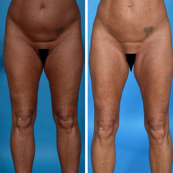Jeff Lisiecki, MD liposuction result — New York, NY