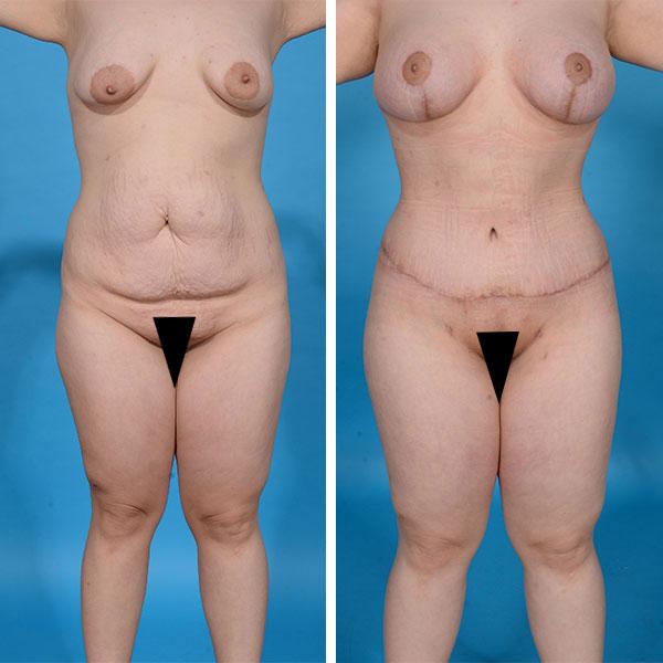 Jeff Lisiecki, MD mommy makeover result — New York, NY